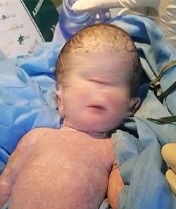 طفلة بعين واحدة
